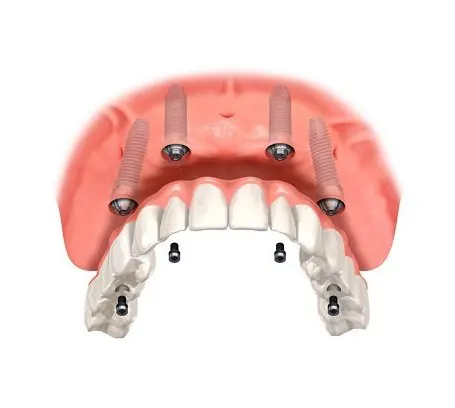 All-on-4 dental implants full arch before and after — full mouth rehabilitation dentist Mumbai India Dr Varun Malhotra PRAXIS Dental