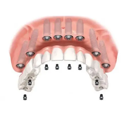 All-on-8 full mouth dental implants gold standard rehabilitation — best full mouth rehabilitation dentist Mumbai India PRAXIS Dental Dr Varun Malhotra