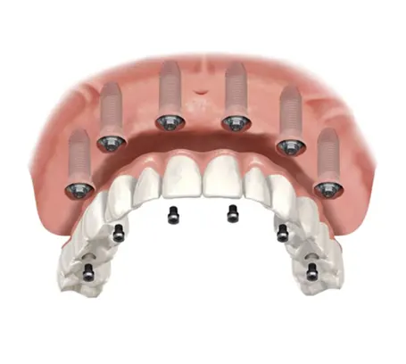 All-on-6 dental implants full arch rehabilitation before and after — full mouth rehabilitation Mumbai India Dr Varun Malhotra PRAXIS Dental