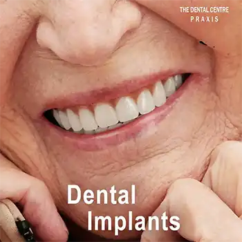 Dental Implants by Dr. Varun Malhotra ( Dental Implant Specialist ), Best Dentist in Mumbai, India