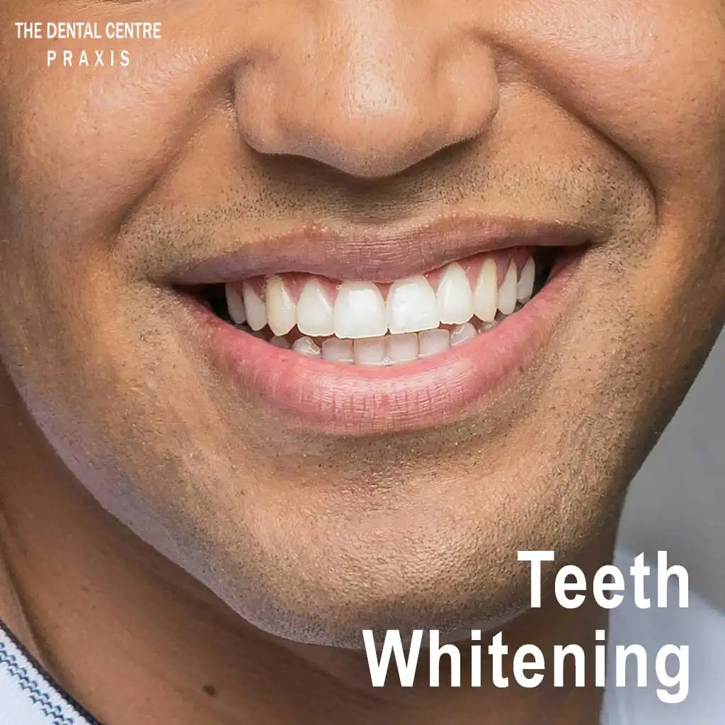 Teeth Whitening in Mumbai India by Dr Varun Malhotra at PRAXIS Dental