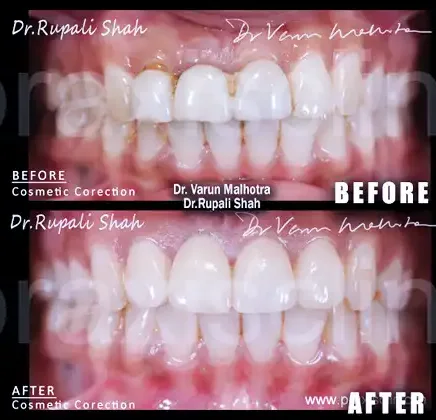 Smile Design Before After Mumbai Patient 3 - Full Smile Makeover
