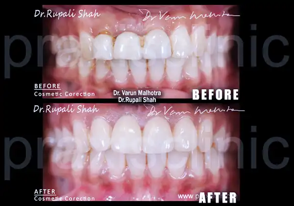 gummy smile treatment best dentist Mumbai