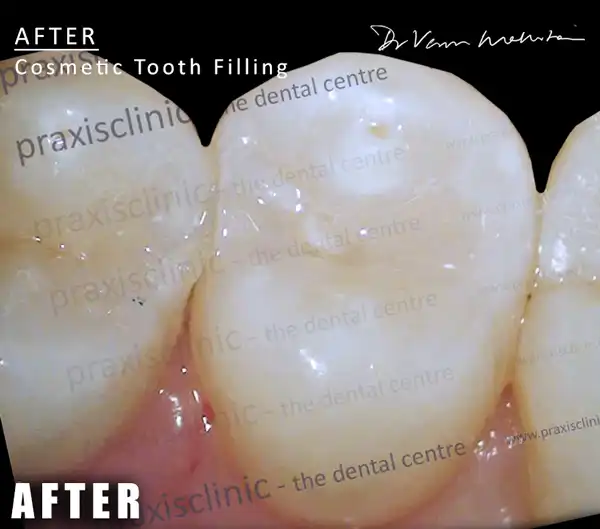 cosmetic fillings cosmetic dentist Mumbai