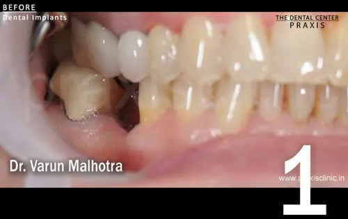 Missing Tooth in the lower jaw of a patient , planned to be replaced with a dental implant at Praxis Dental Clinic, Mumbai, India by Dr Varun Malhotra , Mumbai's Top Dental 
                            Implant surgeon of Mumbai, India 