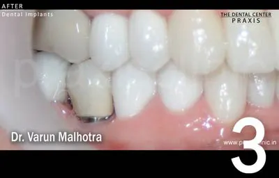 Image of an artificial cap / crown that has been installed on top of the dental implant placed in the site of the missing molar tooth.