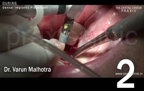 Image of a dental implant being surgically placed at the location of the missing molar tooth in the lower jaw. Dental Implant surgery and images by Dr. Varun Malhotra ( Dental Implant Surgeon ) at PRAXIS, The Dental Centre, Mumbai, India.
