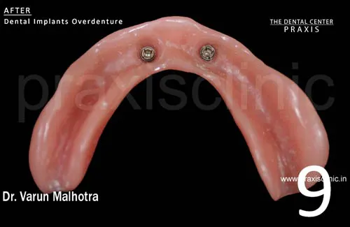 Image of denture of the patient showing specialised attachmnents fitted in their existing
                              denture , which will anchor to the the two dental implants . Dental Implant Surgery by Dr. Varun Malhotra ( Dental Implant Specialist ) at PRAXIS, The Dental Centre, Mumbai, India.