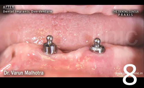Image of lower jaw of a patient showing specialised attachments on top of dental implants 
                                for a Dental Implant Supported Overdenture. Dental Implant Surgery by Dr. Varun Malhotra ( Dental Implant Specialist ) at PRAXIS, The Dental Centre, Mumbai, India.