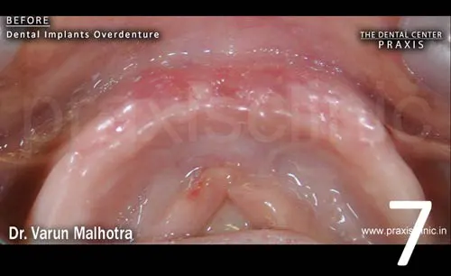 Image of lower jaw of a patient who was wearing dentures since many years , but their dentures had become loose.