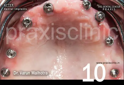 Multiple dental implants surgically  placed in the both jaws of a patient , as part of the planned Full Mouth Rehabilitation to replace all the missing teeth with dental implants at Praxis Dental Clinic by Dr Varun Malhotra, Top Dental 
                        Implant Surgeon of Mumbai India 