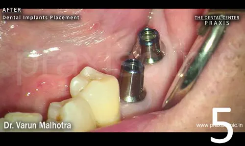 Image of two dental implant abutments on top of two dental implants that have been placed at the site of the two missing molar teeth.
