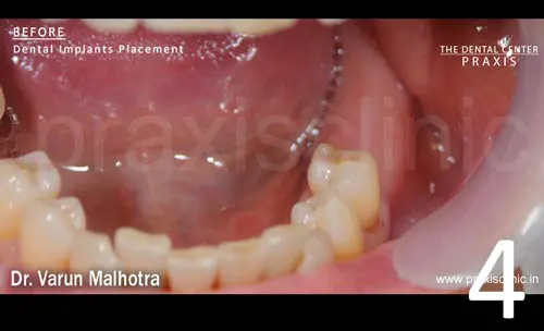 Multiple Missing Teeth in the lower jaw of a patient , planned to be replaced with 2 dental implants at Praxis Dental Clinic, Mumbai, India by Dr Varun Malhotra , Mumbai's Top Dental 
                            Implant surgeon of Mumbai, India 