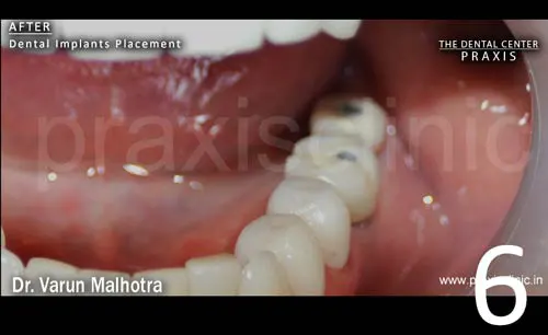 Image of two dental implant abutments on top of two dental implants that have been placed at the site of the two missing molar teeth.