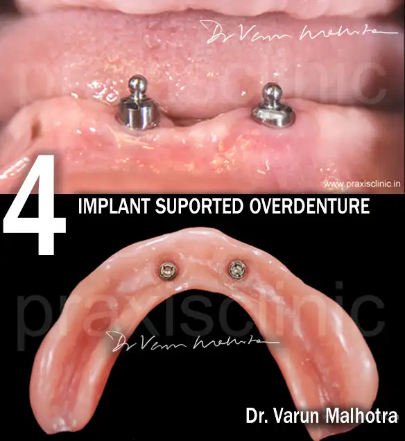 Before and After results of Smile Makeover at Praxis Dental clinic in Mumbai