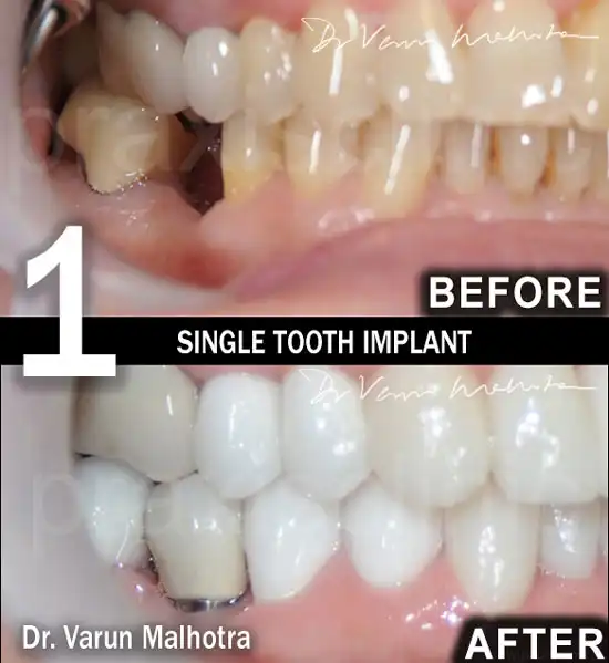 Before and After results of Single Tooth Dental Implant in Mumbai India