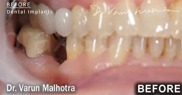 Missing Tooth in the lower jaw of a patient , planned to be replaced with a dental implant at Praxis Dental Clinic, Mumbai, India by Dr Varun Malhotra , Mumbai's Top Dental 
                        Implant surgeon of Mumbai, India 