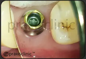 Image of a dental implant abutment . This is a component that is placed on the top of the implant fixture by Dr. Varun Malhotra ( Oral Implantologist ).