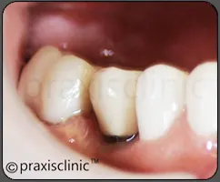  Single artificial Crown / Cap on a Dental Implant to replace a missing molar tooth by Dr. Varun Malhotra ( Oral Implantologist ).