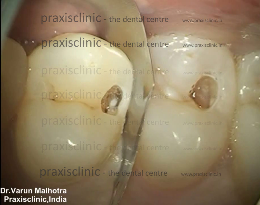 Dental fillings procedure and results at PRAXIS Dental Mumbai — cosmetic dentist Dr Rupali Shah Malhotra, India