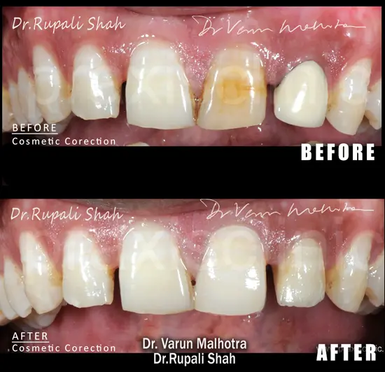 Gummy smile correction and lip repositioning before and after result at PRAXIS Dental Mumbai — cosmetic dentist India Dr Varun Malhotra