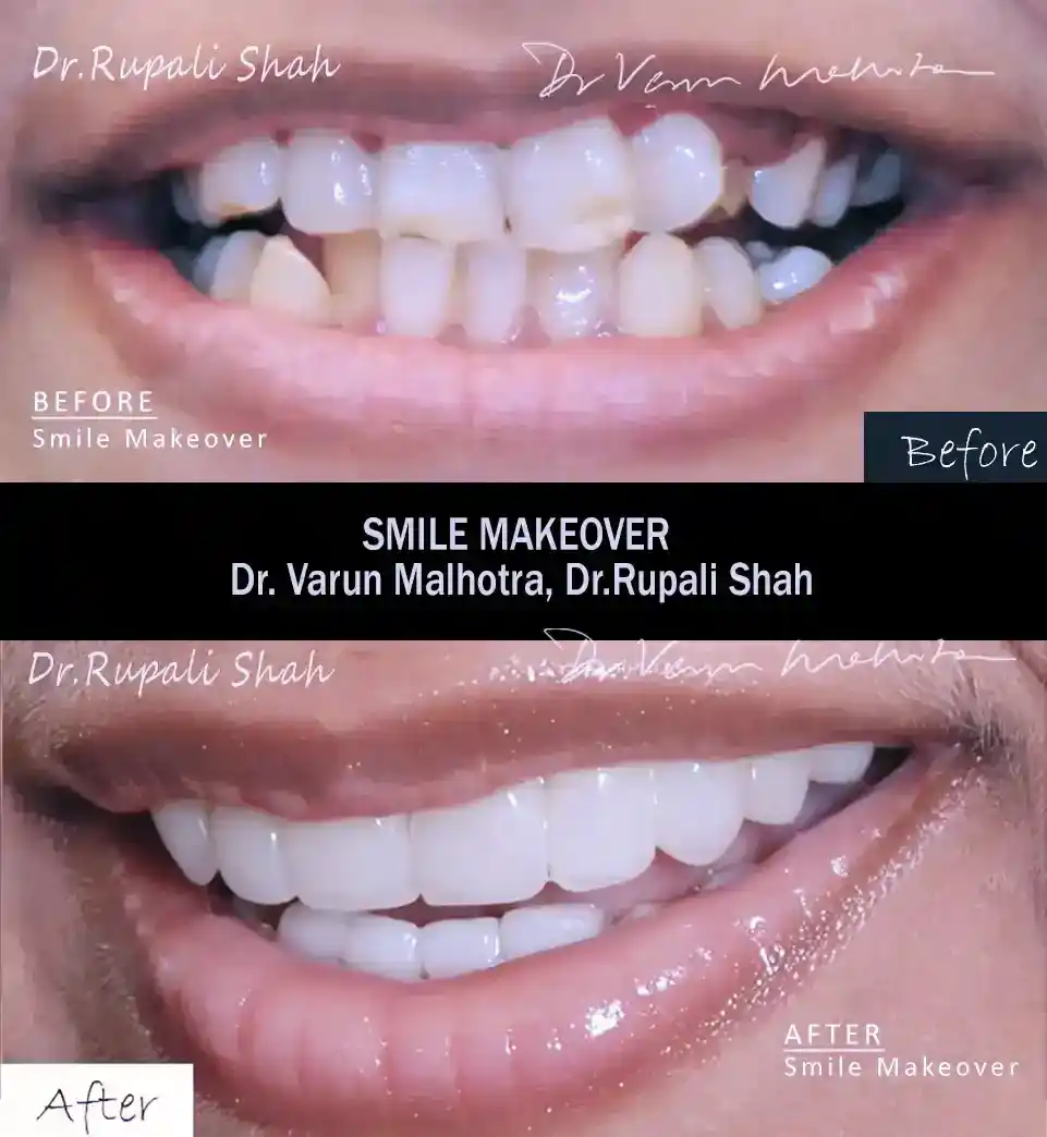 Full smile makeover before and after with porcelain veneers — top smile makeover dentist in India Dr Varun Malhotra PRAXIS Dental Mumbai