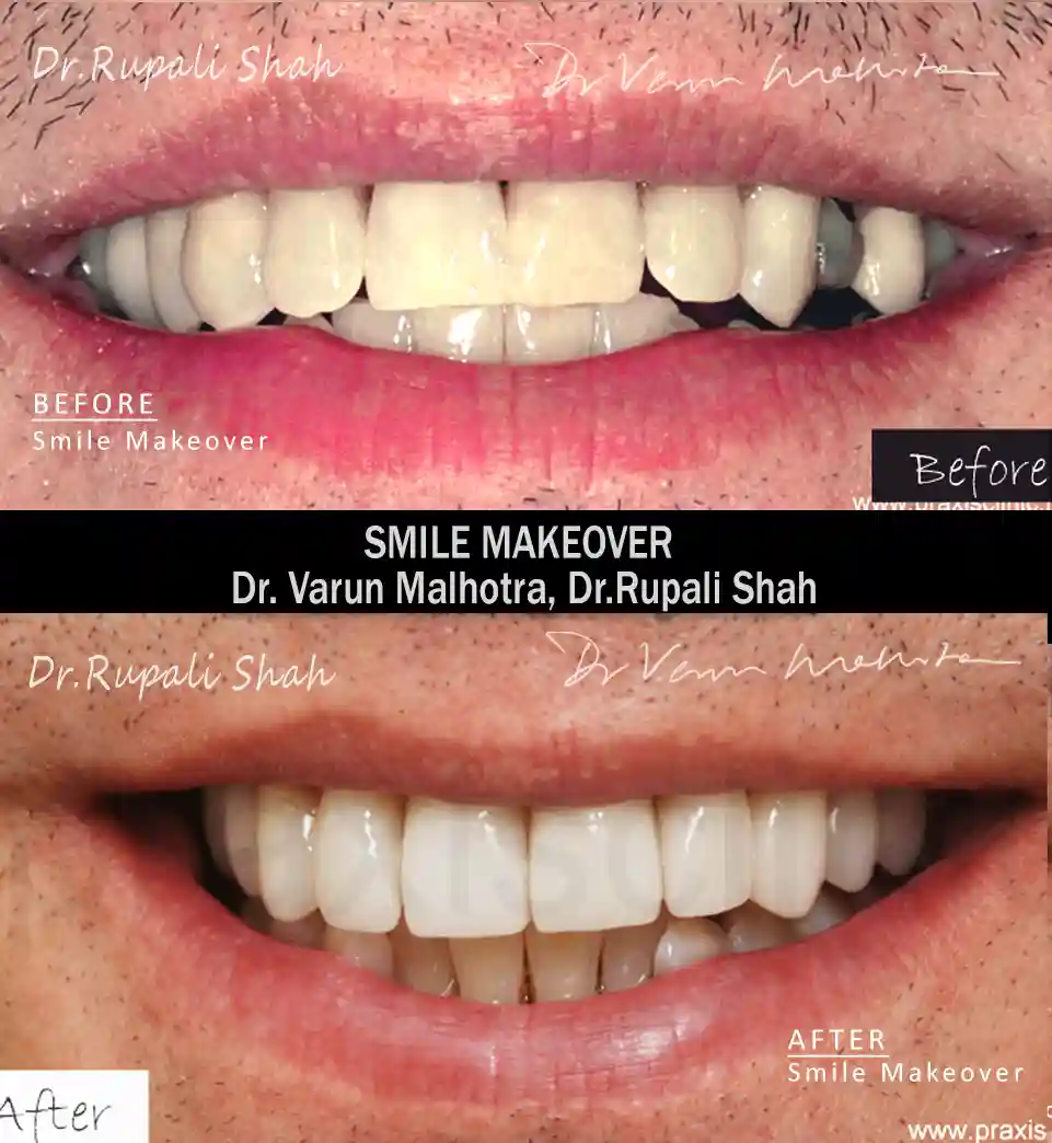 Full mouth rehabilitation combined with smile makeover and cosmetic dentistry  — Dr Varun Malhotra full mouth rehabilitation dentist Mumbai India PRAXIS Dental